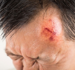 Trabalhador atingido no rosto por pedra lançada pelo chefe tem direito a indenização